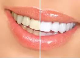 Transforming your smile with Shiny Smile Veneers can seem like a daunting task.
